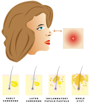Acne is divided into four types