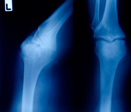 X ray film  of knee fracture
