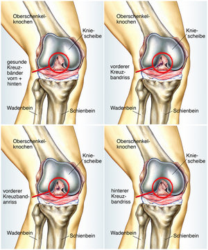meniskus bol meniscus suza medicinsku opremu za liječenje osteoartritisa
