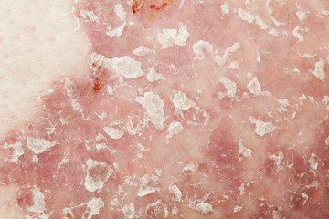 Psoriasis vulgaris is an disease that affects the skin