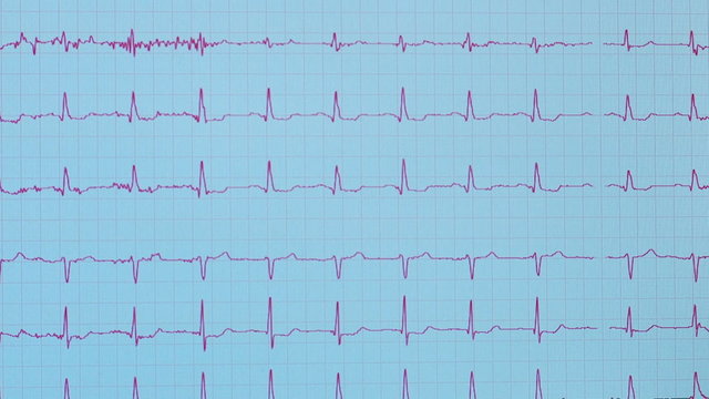 EKG results