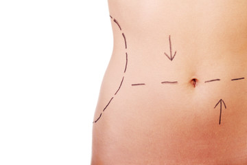 Woman belly marked out fo rcosmetic surgery.