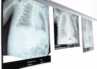 Children's chest x-ray.