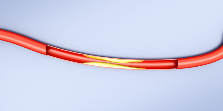 Arteriosklerose.