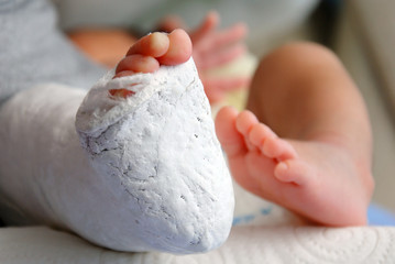 Baby foot in bandage and cast