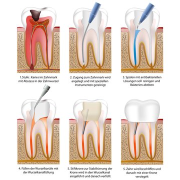 Wurzelbehandlung - root canal treatment with crown