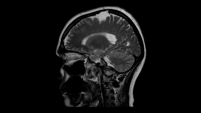 Computed tomography of the brain