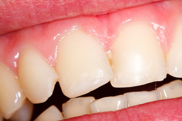 An fractured incisor filled with composite resin.
