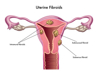 fibroma uterino - obrazy, fototapety, plakaty