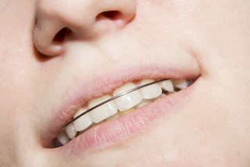 Fototapeta premium the young girl smiling with braces on teeth