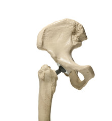 anatomic study model of an human hip replacement