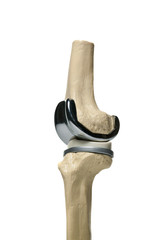 picture of an anatomic study model of an knee replacement