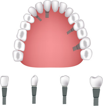 proteasi dentale -dental prosthesis
