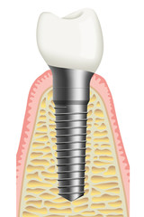 Fototapeta Zahnimplantat / Implantologie obraz