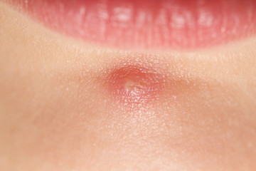 Pimple on a girls chin