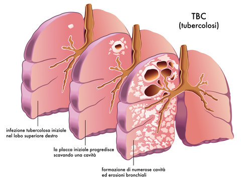 tubercolosi