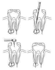 Root canal procedure