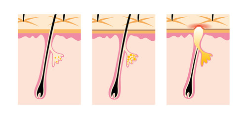 にきびのしくみ
