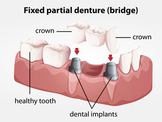 Naklejka premium Fixed partial denture bridge
