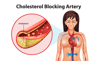 Ateriosclerosis