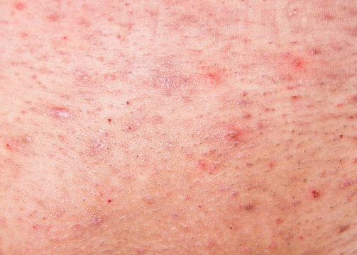 Human skin with acne