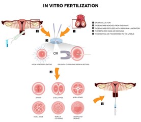 Plakat Zapłodnienie in vitro. Szczegółowe ilustracje