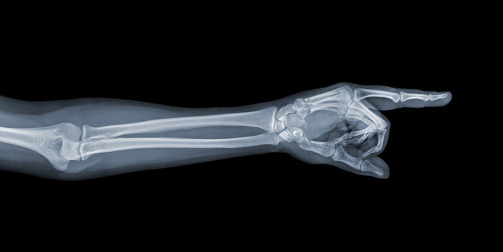 Pointing X-ray hand