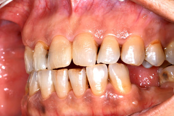 Discolored teeth