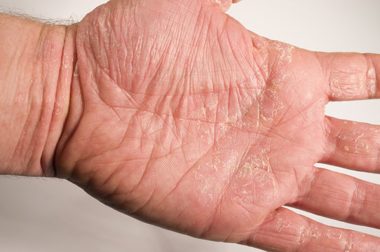 Ekzem Hand