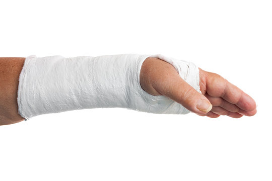 Broken arm with a plaster cast isolated on white