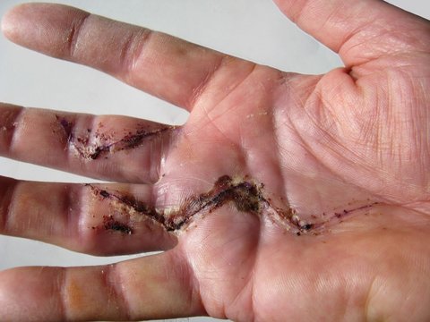 hand scar after dupuytren's disease surgery