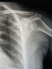 radiografia hombro