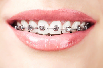 teeth with braces