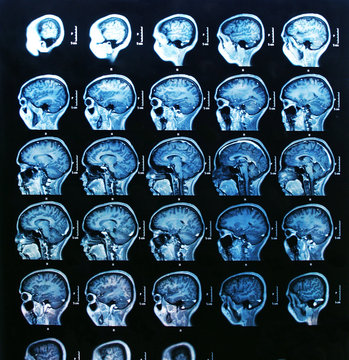IRM du cerveau
