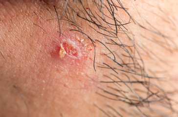 Exploded pimple