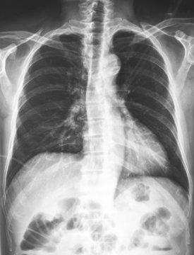 X-ray of the chest