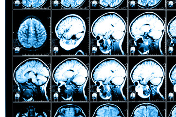 X-ray image of the brain computed tomography