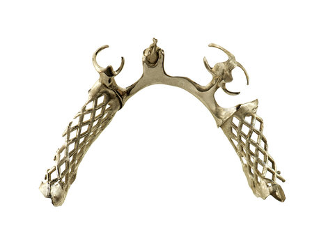 lower dental cast metal frame with clasps