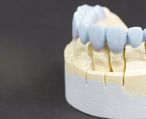 wax denture