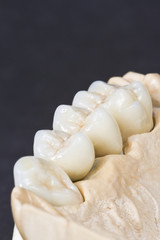 dental ceramic bridge