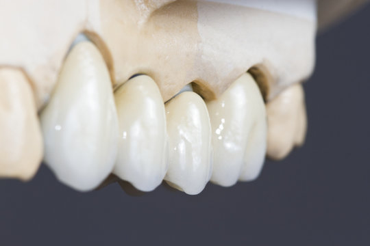 Dental Ceramic Bridge