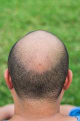 Fototapeta premium A crater in the middle of the head