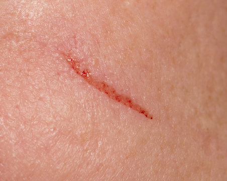 wound on the skin. macro