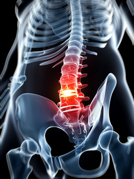 3d rendered illustration - herniated disk