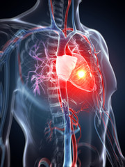 3d rendered illustration - heart attack