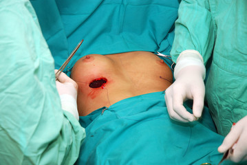 Breast augmentation surgery - obrazy, fototapety, plakaty