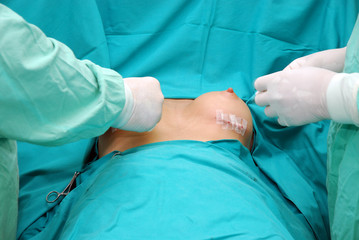 Breast augmentation surgery - obrazy, fototapety, plakaty