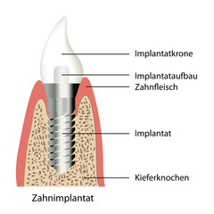 aufbau zahnimplantat ,beschreibung deutsch