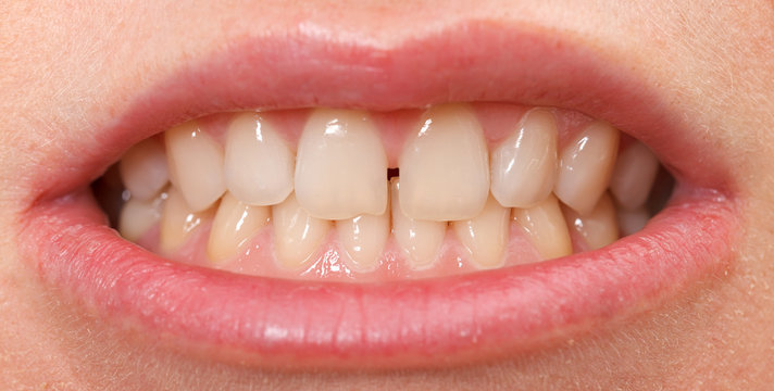 Diastema  between the upper incisors