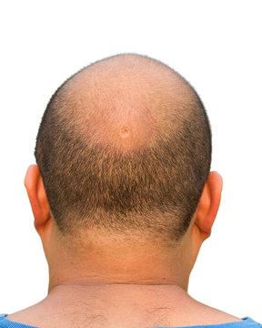 Bald head isolation